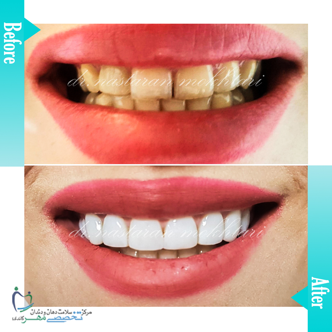 دکتر نسترن مختاری - متخصص ترميمی و زیبایی (کامپوزیت ونیر / لمینیت کامپوزیتی)